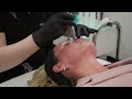 Platelet Rich Plasma with Microneedling with Daria (No Dialogue)