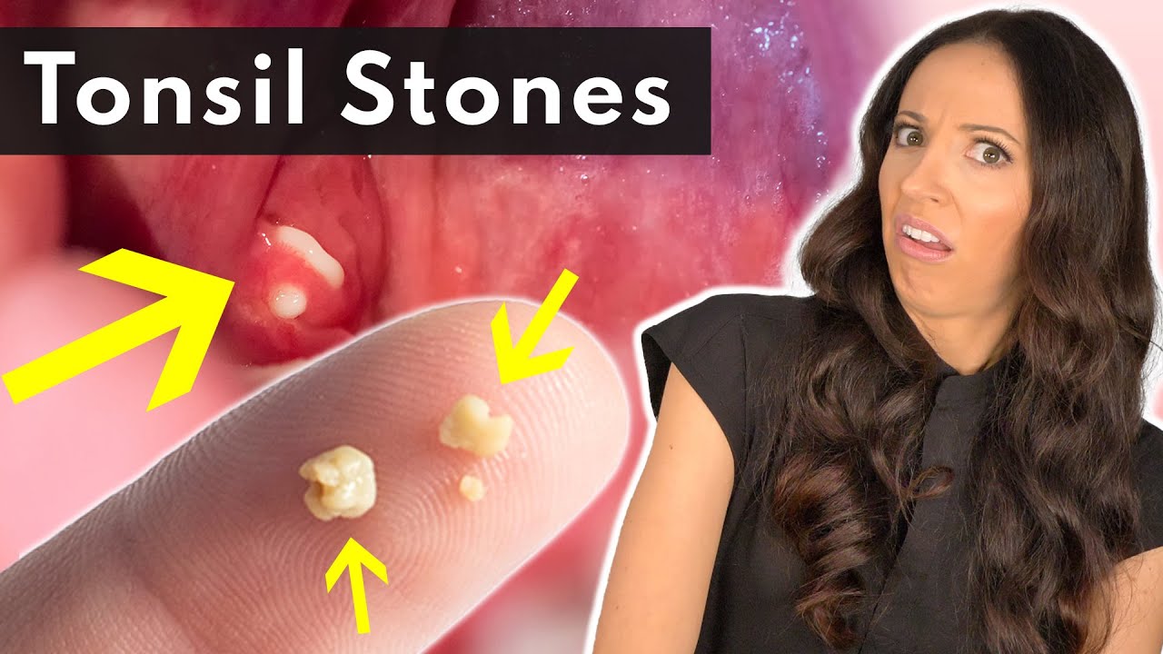 What Are Tonsil Stones & How To SAFELY Remove Them - YouTube