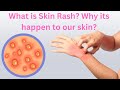 What is Skin Rash? Why its happen to our skin | Med About You