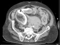 CT Trauma Abdomen hemorrhage DISCUSSION by Radiologist