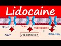 Lidocaine as Local Anesthetic