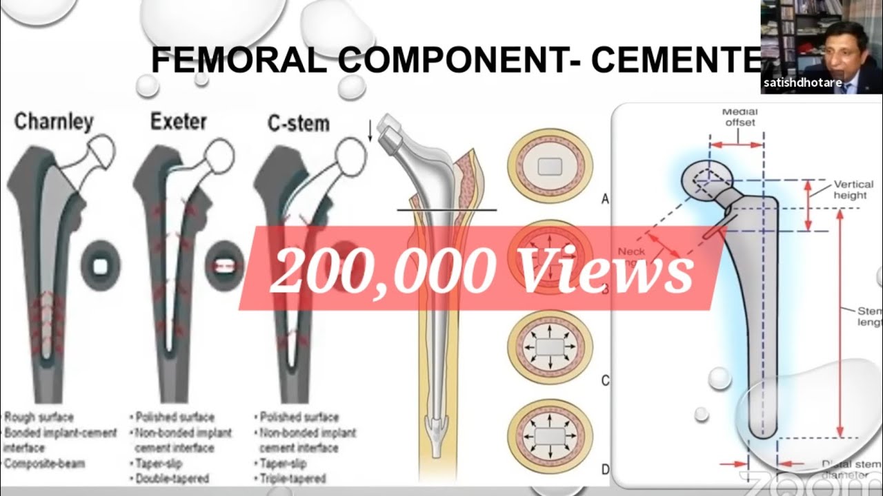 Biomechanics Of Total Hip Replacement For The FRCSOrth - YouTube