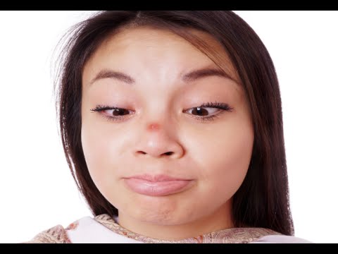How to Get Rid of Red Zits Fast - Zits On Face How to Get Rid of Red Zits Fast - Zits On Face