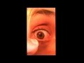 Fishing eye syndrome. Eye Worm Fishing eye syndrome. Eye Worm