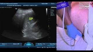 Hot Tips - Scanning the Spleen in the Supine Position