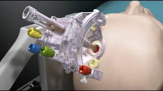ClearPoint Demonstration Video
