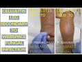 #Cellulitisleg  #fungalinfectionfoot #DrPremsDiabeticFoot | #footcarepurasawalkam #Diabetes