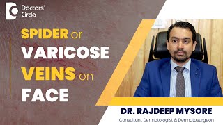 Spider Veins/Varicose Veins On Face-Tips to Get Rid of it!#beauty -Dr.Rajdeep Mysore|Doctors' Circle