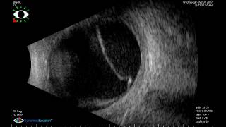 Asteroid Hyalosis On B Scan