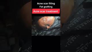 Pimple Popping Videos - Satisfying Cysts, Blackheads and Pimples Videos #shorts#cyst #acnetreatment