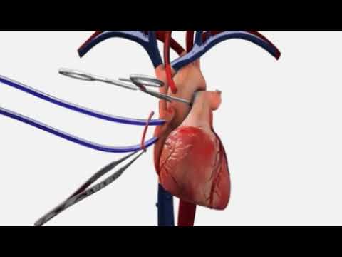 Heart Surgery ♥ - YouTube