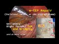 e TEP  Repair.  Unilateral TAR and Bridging. Metin Ertem MD.FACS