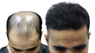 Hair loss in 6th Grade Treated Through Hair Transplantation In India With Successful Outcome 💁