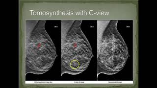 RADT 221 Mammography