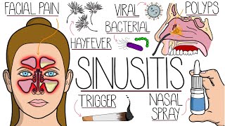 Sinusitis Explained Clearly