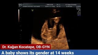 How is a baby boy seen on ultrasound at around 14 weeks. Can this be a misdiagnosis?