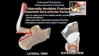 Calcaneal Fractures Extra articular Fractures - Everything You Need To Know - Dr. Nabil Ebraheim