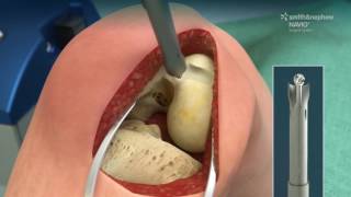 Animated overview of NAVIO Surgical System