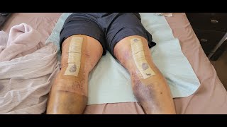 Bilateral Total Knee Replacement 12 days Post Operation TKR Sports Quick Recovery BTKR Pain DR Lies