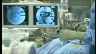 Minimally invasive lumbar spine surgery: XLIF®
