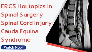 FRCS Hot topics in Spinal Surgery - Spinal Cord Injury | Cauda Equina Syndrome