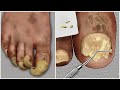 [ASMR] 두꺼운 무좀 발톱 케어 애니메이션 / thick athlete's foot toenail treatment animation