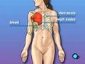 PreOp® Patient Education : Mastectomy Total Surgery