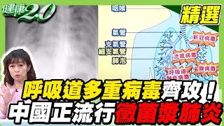 流感、呼吸道多重病毒齊攻！ 中國正流行黴漿菌肺炎 台大醫警告：台灣恐大爆發 流感突胸痛、喘 當心大白廢釀壞死性肺炎！ 【健康2.0精選】