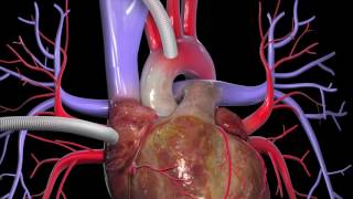 Learn about coronary artery bypass graft