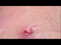 Satisfaction and Blackheads Video with Hạnh Đào Treatment 2021 #04