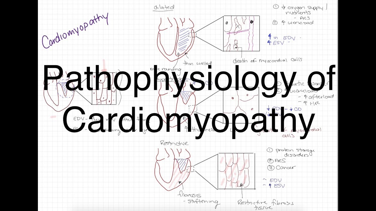 Pathophysiology Of Cardiomyopathy Youtube