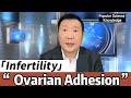 Ovarian Infertility - Ovarian Adhesion- Antai Hospitals