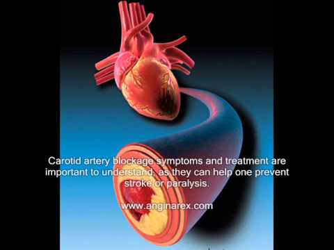 artery blockage treatment artery blockage treatment