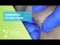 Managing Ethnic skin (Extractions part 2)