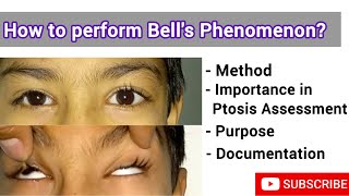 Bell's Phenomenon in Optometry | Understanding Eye Movement and Reflexes