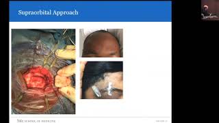 Minimally Invasive Approaches to the Skull Base