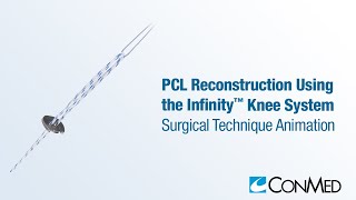 PCL Reconstruction Using the Infinity™ Knee System - CONMED Animation