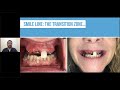 Dr. Mark Bishara: Digital Approaches to Complete Fully Guided Edentulous Treatment