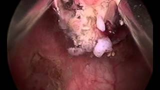 Resection of small bladder tumour - The Prostate Clinic