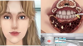 asmr remove parasites from camper's mouth trypophobia cautious entry 기생충 감염 치료