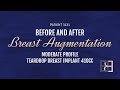 410cc Breast Implants (Augmentation Mammaplasty) {Patient 3131} Before & After