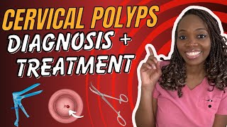 How cervical polyps are diagnosed and treated. Cervical polyps miniseries - conclusion.