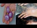 White Hair Turn To Black Hair Naturally Permanently with Onion | How to get rid gray hair naturally