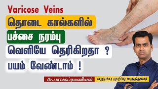 Varicose Vein-Cause தொடை கால்களில்  பச்சை நரம்பு வெளியே தெரிகிறதா ?பயம் வேண்டாம்