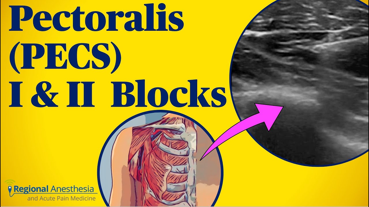 Pectoralis (PECS) Blocks I & II - YouTube