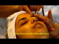 Microdermabrasion Process at aura skin care and laser Burnaby