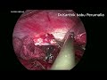 Laparoscopic Right Adrenalectomy for a 15 x 12 cm right Adrenal gland tumor