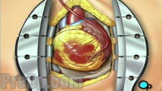 Coronary Artery Bypass Graft (CABG off-pump) PreOp® Patient Engagement and Education