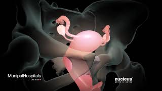 How Is A Robotic Hysterectomy Done? | Robotic Hysterectomy Surgery | Gynaecology - Manipal Hospitals