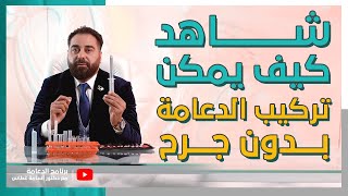 شاهد كيف يمكن تركيب الدعامة بدون جرح| برنامج الدعامة 41